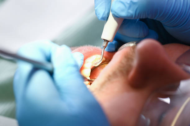 Best Emergency Dentist for Lost Fillings or Crowns in Grantsville, UT